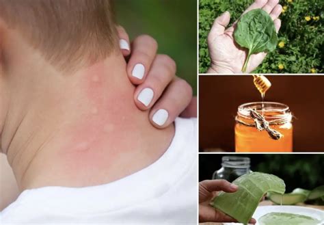 4 Ways To Get Rid Of Mosquito Bites Grandmas Things