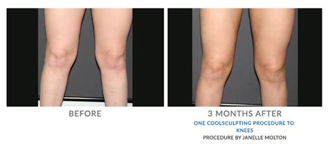 Coolsculpting By Zeltiq Adelaide Fat Freezing Epiclinic