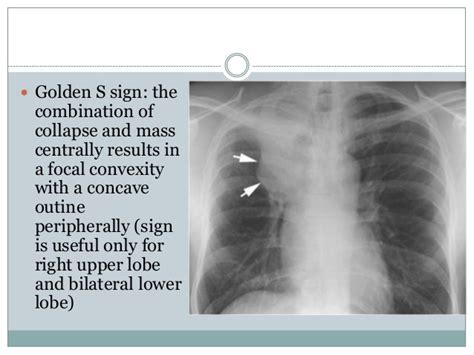 Chest Radiography Collapse
