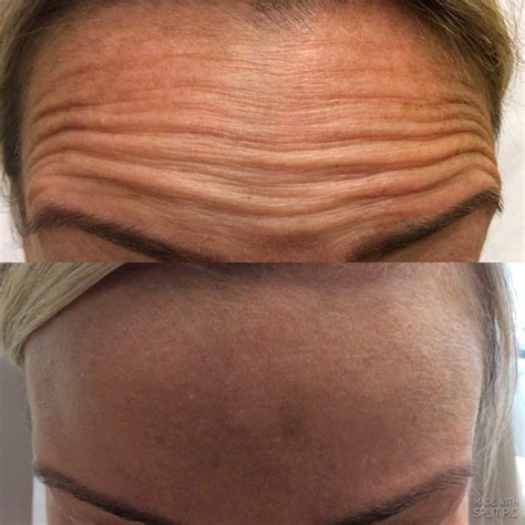 Botox Before And After Pictures Deep Forehead Wrinkle Lips