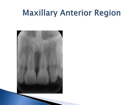Ppt Eo Normal Intraoral Radiographic Anatomy Powerpoint