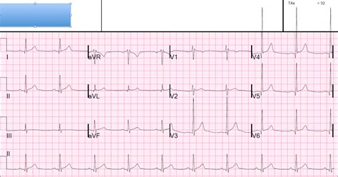 Dr Smiths Ecg Blog Syncope And A Possible Type 2 Brugada Morphology