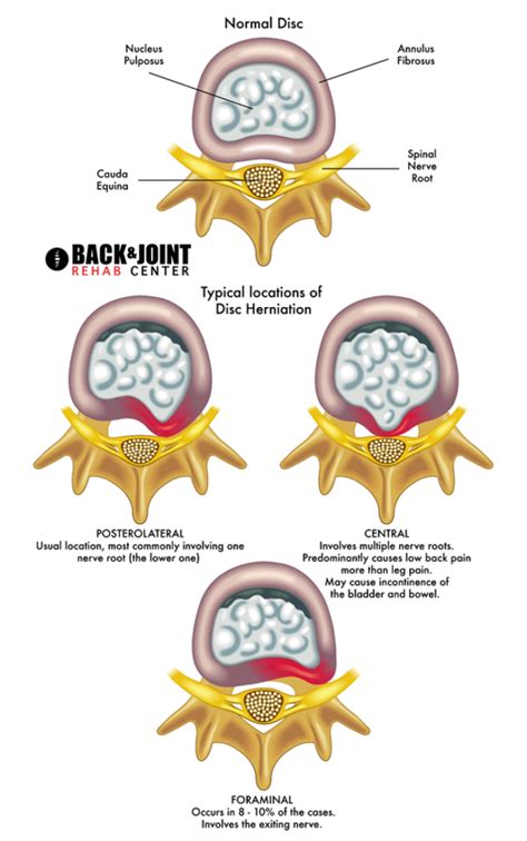 Herniated Disc Disc Herniation Chiropractor Lower Back Pain Therapy