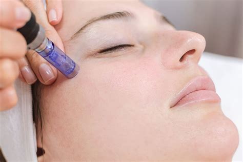 Microneedling Apex Center For Regenerative Medicine