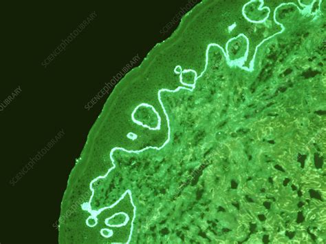 Bullous Pemphigoid Fluorescent Light Micrograph Stock Image C052