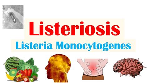 Listeriosis Listeria Monocytogenes Sources Pathophysiology
