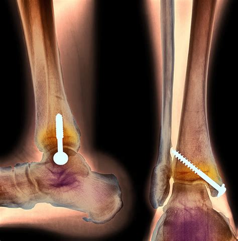 Pinned Ankle Fracture Two Views X Ray Photograph By Pixels