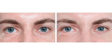 Before And After Eyelid Revision Surgery Raymond Douglas