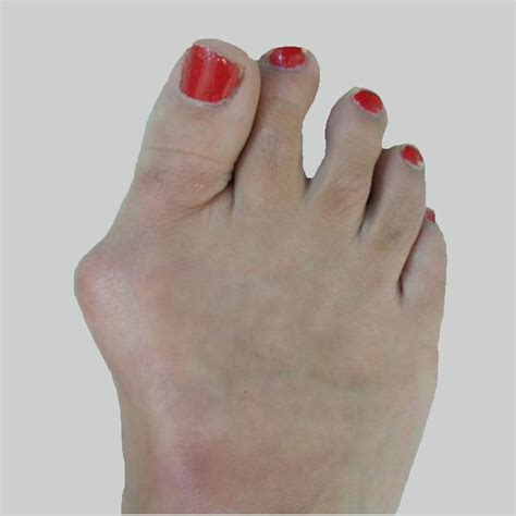 Bunions The Foot People