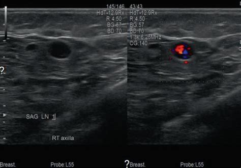 Suspicious Axillary Lymphadenopathy With Aberrant Blood Flow