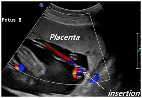 Jcm Free Full Text Clinical Significance Of Velamentous Cord Insertion Prenatally Diagnosed