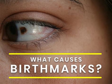 Do You Have A Birthmark Its Causes Types Complications And Treatment