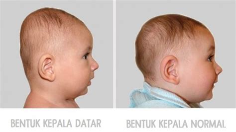 Cradle cap umumnya muncul di kulit kepala dan di belakang telinga, namun bisa juga muncul di sekitar alis, kelopak mata bayi, atau ketiak dan lipatan tubuh lainnya. COBA LIHAT KEPALA BAYI ANDA, JIKA BENTUKNYA DATAR, INILAH ...