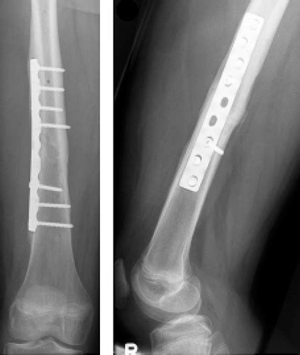 Femoral Shaft Fractures Trauma Orthobullets