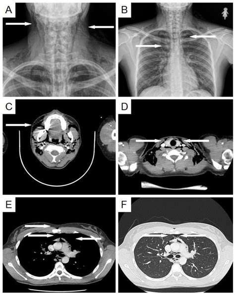 Figure From Pneumomediastinum And Subcutaneous Emphysema May Follow