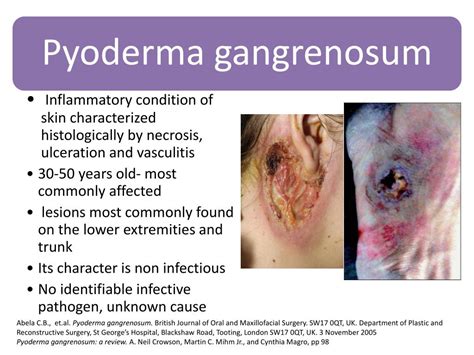 Ppt Pyoderma Gangrenosum Powerpoint Presentation Free Download Id