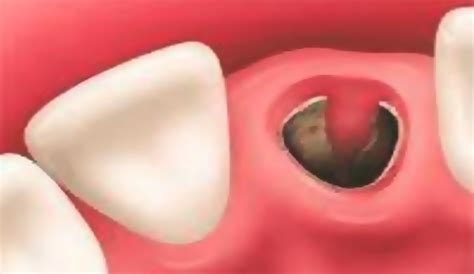 Nov 07, 2018 · you might have a case of dry socket, which happens when a blood clot is dislodged at the site of tooth extraction. Emergency Dry Socket Treatment | 4 London Clinics