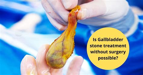 Is Gallbladder Stone Treatment Without Surgery Possible Dr Maran