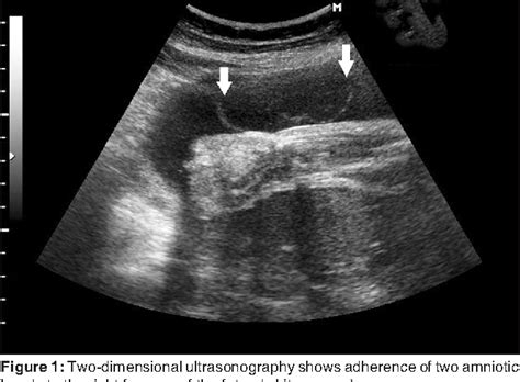 Figure 1 From Prenatal Diagnosis Of Amniotic Band Syndrome In The Third