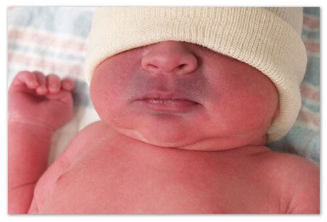 The Baby Has A Nasolabial Triangle Causes Of Cyanosis Dr Komarovsky