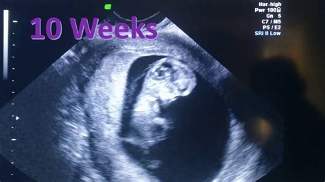 Ultrasound Of Child Movement At 10 Weeks Youtube