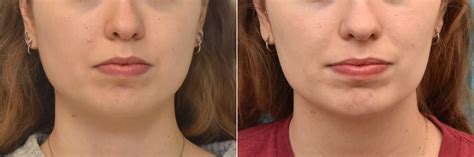 Facial Slimming Buccal Fat Removal Injectable Fillers Photos