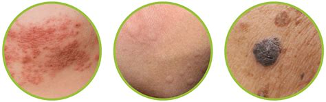 Skin Condition Circles Directderm