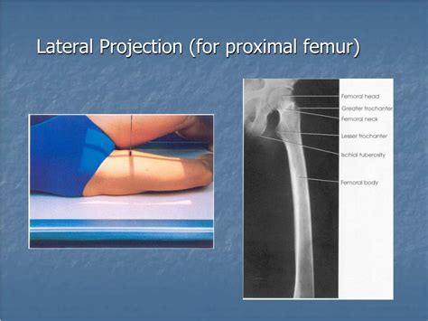 Femur Proximal Lateral X Ray Polymed Lab