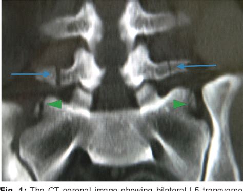 Figure From Bilateral L Transverse Process Fracture Implications