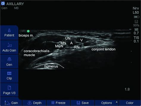 Ultrasound Guided Axillary Brachial Plexus Block Anesthesia Key