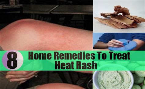 8 Excellent Home Remedies To Treat Heat Rash Natural Home Remedies
