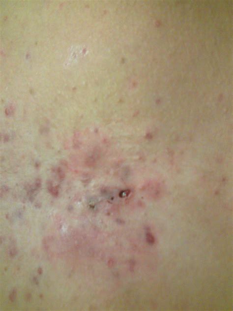Severe Chest Acne Need Advice Scar Treatments Community