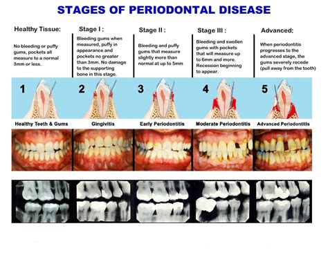 Periodontitis Stages Symptoms And Treatments Austin Laser Dentist Hot Sex Picture