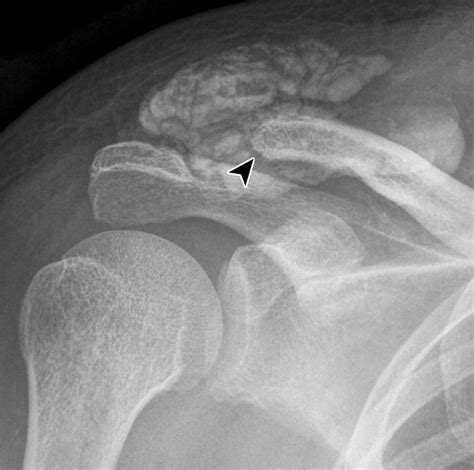 Imaging Of The Acromioclavicular Joint Anatomy Function Pathologic