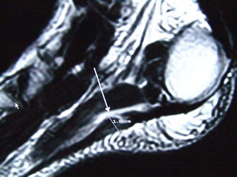 Plantar Fascial Rupture Of The Foot A Case Report The Foot And Ankle