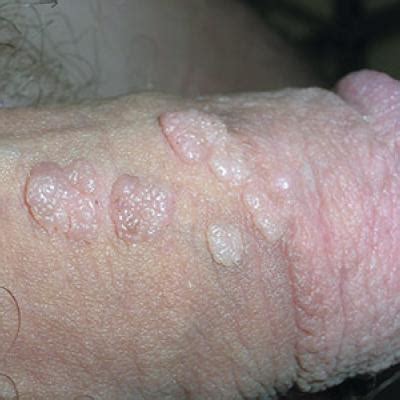 Bumps On Penis After Sex Telegraph