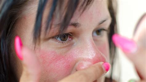 Résumé De 16 Articles Sur Le Sujet Allergie Visage Que Faire