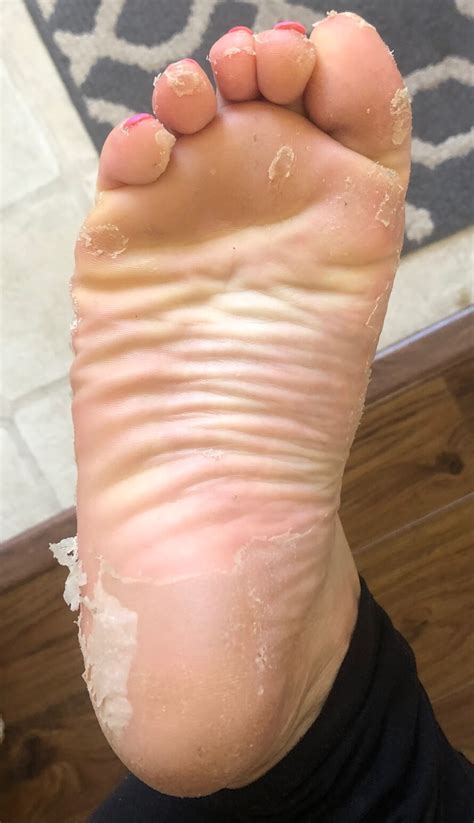 what to know before you do a foot peel