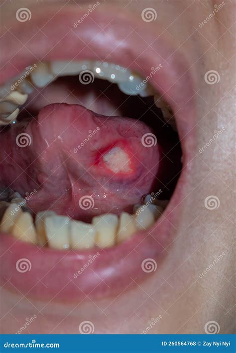 Ulcer At The Tongue Of Asian Patient Diagnosis May Be Aphthous Ulcer