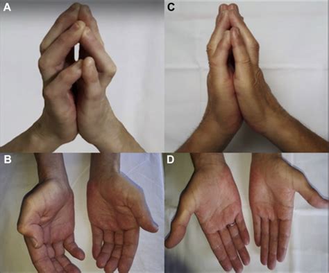 Eosinophilic Fasciitis Triggered By Nivolumab A Remarkable Efficacy Of