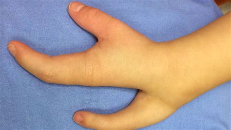 Congenital Hand Deformity
