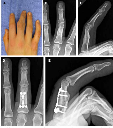 Figure 3 From Complications After The Fractures Of Metacarpal And