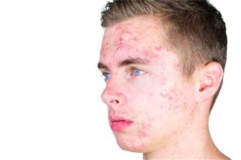 Different Types Of Acne Acne Cure