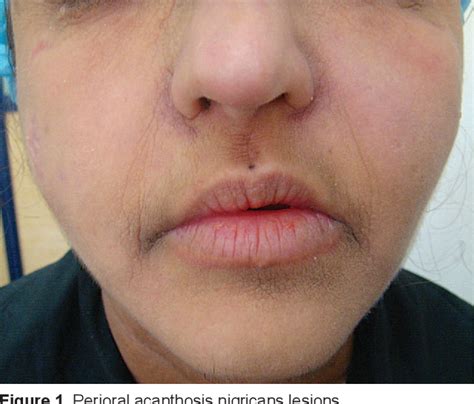 Figure 1 From Crouzon Syndrome In Association With Acanthosis Nigricans