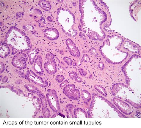 Pathology Outlines Tubulocystic Renal Cell Carcinoma