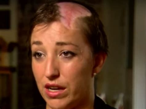 Mother Shares Important Warning After Being Scalped By Her Car