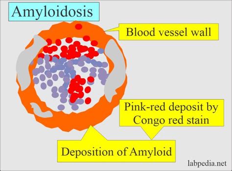Amyloidosis Samples And Diagnosis