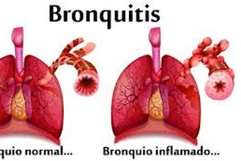 La Bronquitis Y Los Remedios Para Tratarla Itg Salud