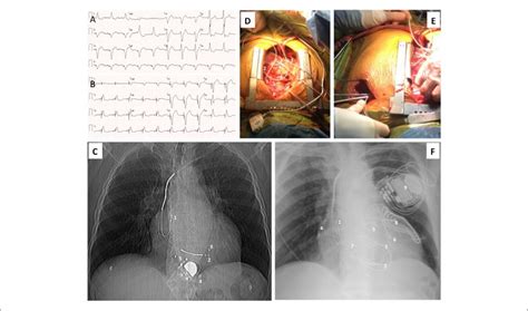 Surgical Epicardial Crt D Implantation In A Patient With Complete