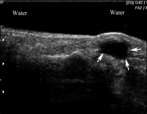 Sonography First For Subcutaneous Abscess And Cellulitis Evaluation